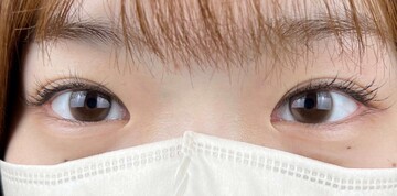 AI Beauty Clinicの二重の症例写真[ビフォー]