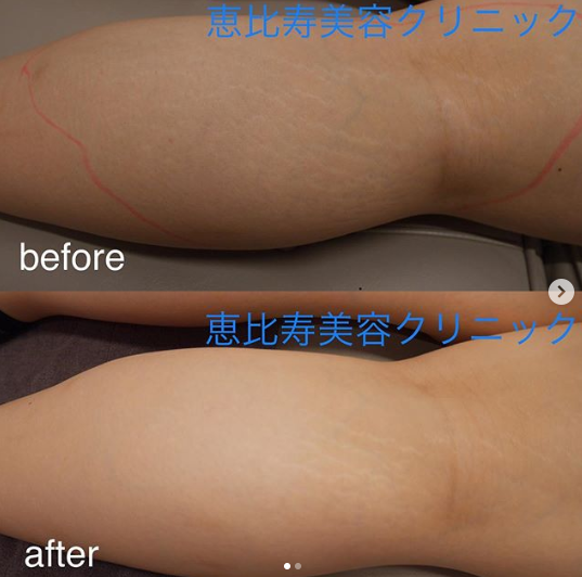 ふくらはぎの肉割れ治療 肉割れ 妊娠線の治療の症例写真 画像 恵比寿美容クリニック Cs 美容医療の口コミ広場