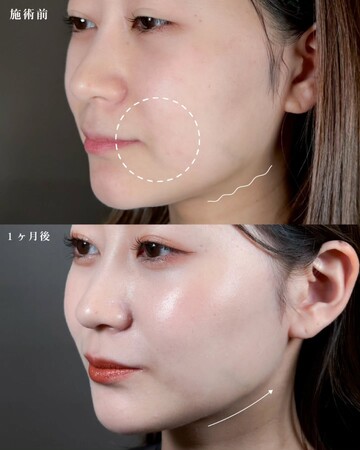 パルム美容クリニックのしわ・たるみ整形(注入、糸、フェイスリフト)の症例写真