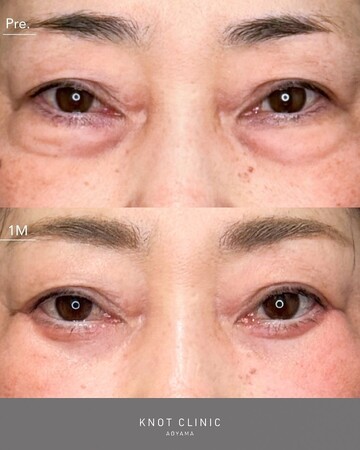 KNOT CLINIC AOYAMAの目元・クマ・眉下・涙袋整形の症例写真