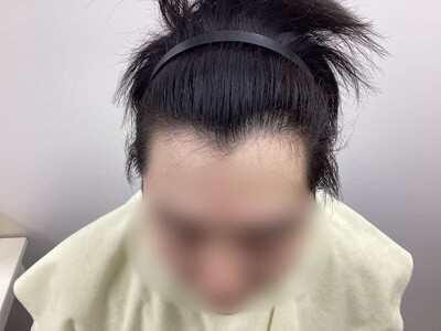 ヘアアートメイク｜20代｜2回の症例写真[ビフォー]