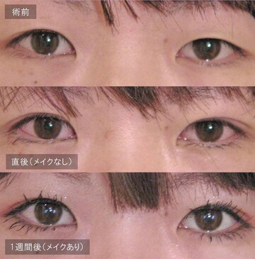 アーティスクリニックの目・二重整形の症例写真