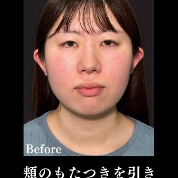 PRISM Beauty Clinicのリフトアップの症例写真[ビフォー]