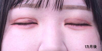 20代　女性　全切開法＋脱脂,たるみ切除、挙筋腱膜前転術　の症例写真[アフター]
