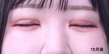 医療法人秀晄会 心斎橋コムロ美容外科クリニックの症例写真[アフター]