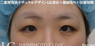 静岡美容外科橋本クリニックの目・二重整形の症例写真[ビフォー]