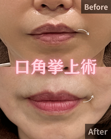 CHARIS BEAUTY CLINICの口元・唇の整形・人中短縮の症例写真