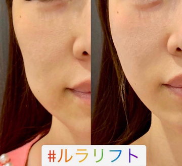 ルラ（LULA）美容クリニックのしわ・たるみ整形(注入、糸、フェイスリフト)の症例写真