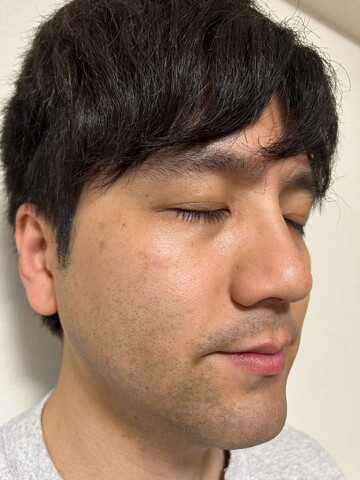 フェミークリニックの医療脱毛の症例写真[ビフォー]