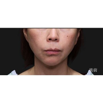 聖心美容クリニックのリフトアップの症例写真[ビフォー]