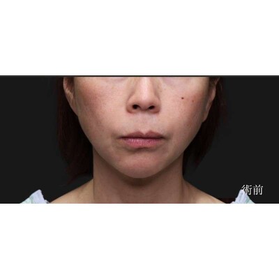 他院フェイスリフト後の再リフトでさらにシャープにの症例写真[ビフォー]