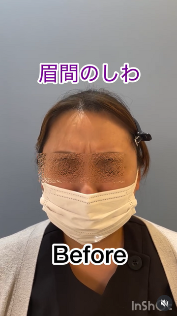 みやもと美容クリニックのしわ・たるみ整形(注入、糸、フェイスリフト)の症例写真[ビフォー]