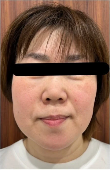 ガーベラ美容クリニックの症例写真[アフター]