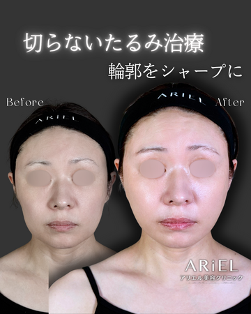 アリエル美容クリニック 郡山院のしわ・たるみ整形(注入、糸、フェイスリフト)の症例写真