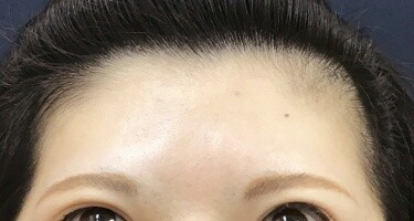 しわボトックス（額）の症例写真[アフター]