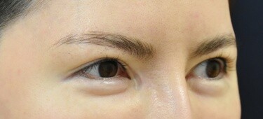 他院目頭切開術後の症例写真[ビフォー]