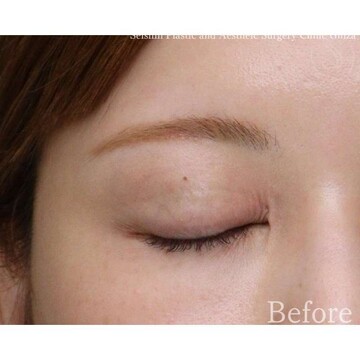 聖心美容クリニックの二重の症例写真[ビフォー]