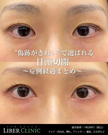 LIBER CLINIC （リベルクリニック）の目・二重整形の症例写真
