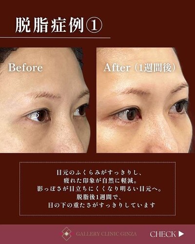 疲れた印象を改善 クマ取り（脱脂）の症例写真