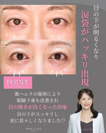 KNOT CLINIC AOYAMAの目元・クマ・眉下・涙袋整形の症例写真