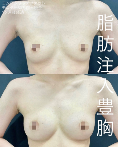脂肪注入豊胸の症例写真