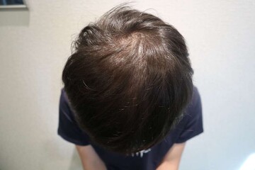 AGAスキンクリニックの薄毛治療の症例写真[ビフォー]