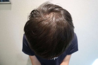 Rebirth+ミノキジェット｜20代｜4か月の症例写真[ビフォー]