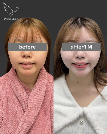Plume Clinicの脂肪吸引の症例写真