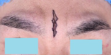 医療法人秀晄会 心斎橋コムロ美容外科クリニックのしわ・たるみ整形(注入、糸、フェイスリフト)の症例写真