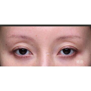 聖心美容クリニックの二重の症例写真[ビフォー]