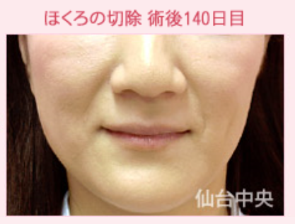 黒子除去 顎の黒子 ほくろのレーザー治療 皮膚切除術 Vビームレーザー ほくろ除去 あざ治療 その他 ほくろ除去 の症例写真 画像 仙台中央クリニック Cs 美容医療の口コミ広場