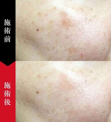 椿クリニックのシミ取り・肝斑・毛穴治療の症例写真