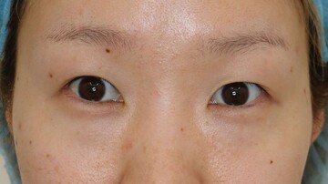 すなおクリニックの二重の症例写真[ビフォー]