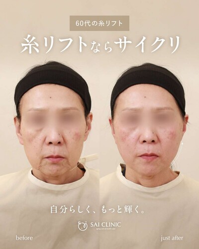 糸リフト（SAI LIFT PERFECT）18本の症例写真