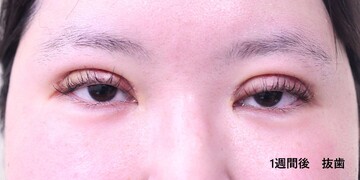 医療法人秀晄会 心斎橋コムロ美容外科クリニックの症例写真[アフター]