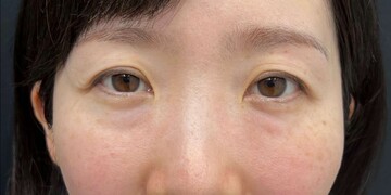 AI Beauty Clinicの目元・クマ・眉下・涙袋整形の症例写真[ビフォー]