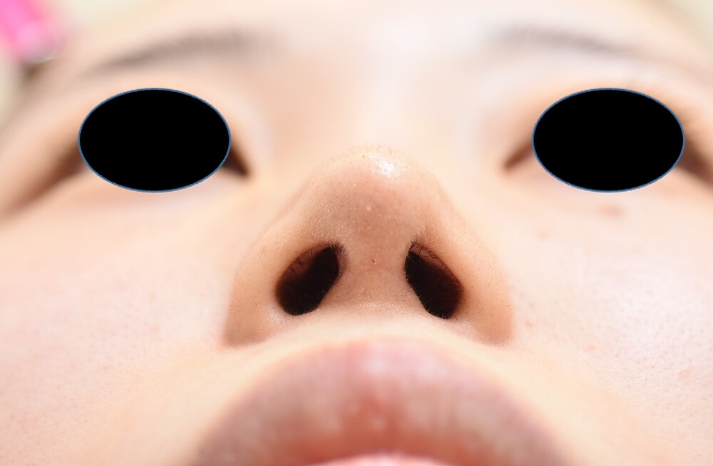 鼻尖形成術で失敗しないためのポイント (鼻尖縮小術、その他(鼻の整形)の症例写真・画像) みずほクリニック (CS73252)《美容医療の口コミ広場》 鼻尖形成術で失敗しないためのポイント (鼻尖縮小術、その他(鼻の整形)の症例写真・画像) みずほクリニック (CS73252)《美容医療の口コミ広場》