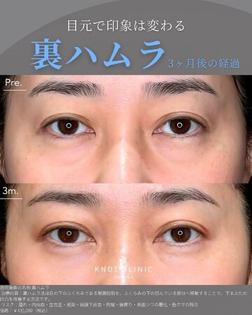 KNOT CLINIC AOYAMAの目元・クマ・眉下・涙袋整形の症例写真