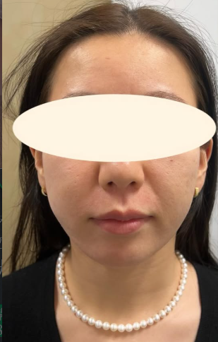 Plume Clinicのしわ・たるみ整形(注入、糸、フェイスリフト)の症例写真[ビフォー]