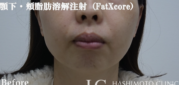 静岡美容外科橋本クリニックの輪郭・顎・エラ・額・小顔整形の症例写真[ビフォー]