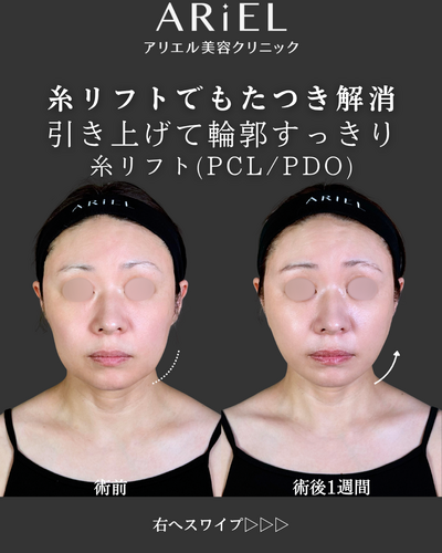 糸リフトの症例写真