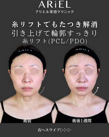 アリエル美容クリニック 郡山院のしわ・たるみ整形(注入、糸、フェイスリフト)の症例写真