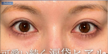 PRISM Beauty Clinicの目元・クマ・眉下・涙袋整形の症例写真[ビフォー]