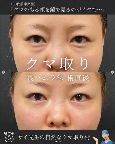 裏ハムラの症例写真