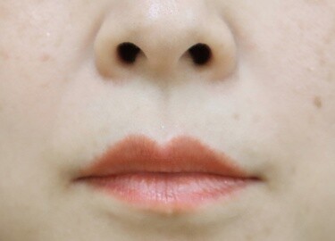 口角ボトックスの症例写真[ビフォー]