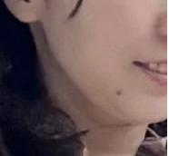 ペルラクリニック神宮前のリフトアップの症例写真[ビフォー]