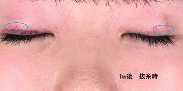 医療法人秀晄会 心斎橋コムロ美容外科クリニックの症例写真[アフター]