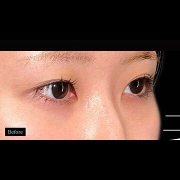 PRISM Beauty Clinicの二重の症例写真[ビフォー]