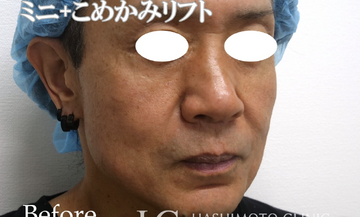 静岡美容外科橋本クリニックのしわ・たるみ整形(注入、糸、フェイスリフト)の症例写真[ビフォー]