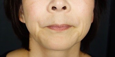 顎 あご 梅干しジワ治療 その他 顔のしわ たるみ しわ取りボトックスの症例 Select Clinic セレクトクリニック Cs 美容医療の口コミ広場